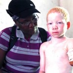 Persons with Albinism (PWA): Ghosts of Tanzania person-with-albinism-2